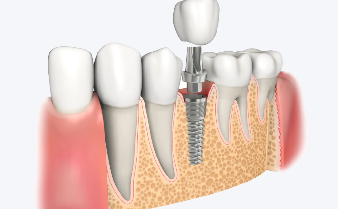 深圳贝臣口腔种植牙的优势