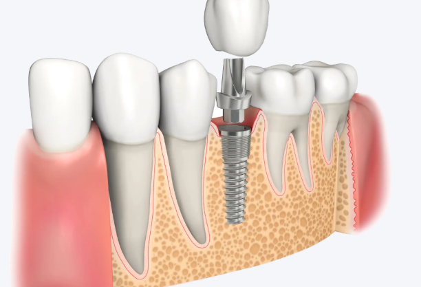 常州口腔医院24小时在线问诊种牙收费标准