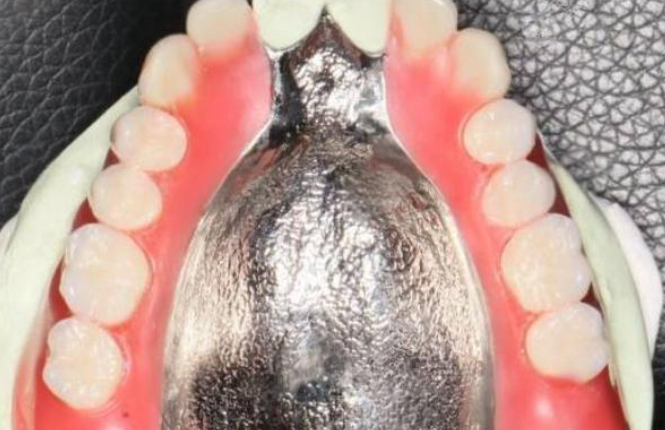 纯钛义齿和吸附性义齿哪个好？牙床条件好选纯钛义齿，全口无牙选吸附性义齿