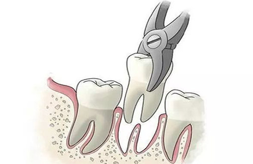 拔牙后三天还疼就一定是干槽症吗？揭秘拔完牙三四天隐隐疼的真相