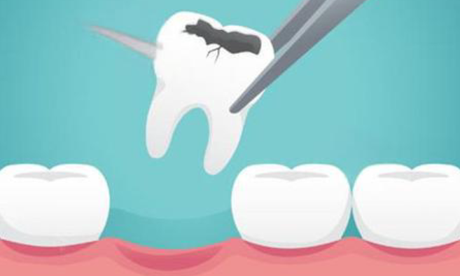 拔牙后三天还疼就一定是干槽症吗？揭秘拔完牙三四天隐隐疼的真相