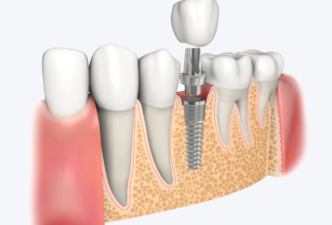 想知道赣州李德贞口腔怎么样？从机构实力到种牙项目的真实分享
