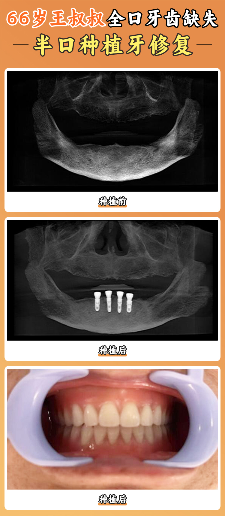 上海亿大口腔半口种植牙价格表公布！半口重建低至18000元起，All-on-4技术当天就能吃东西！