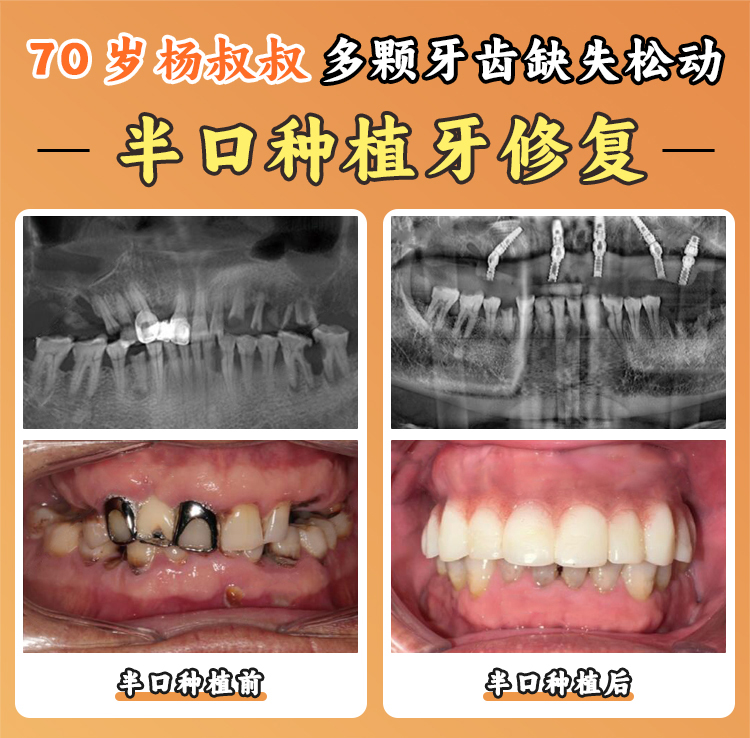 上海亿大口腔半口种植牙价格表公布！半口重建低至18000元起，All-on-4技术当天就能吃东西！