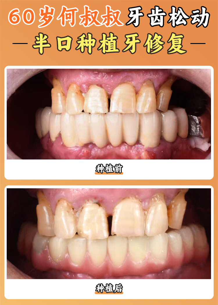 上海亿大口腔半口种植牙价格表公布！半口重建低至18000元起，All-on-4技术当天就能吃东西！