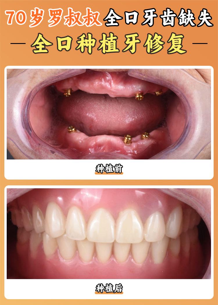 上海装全口假牙多少钱？活动/吸附性/种植义齿价格对比：2500-2.8万不等，附5家上海老人装假牙医院