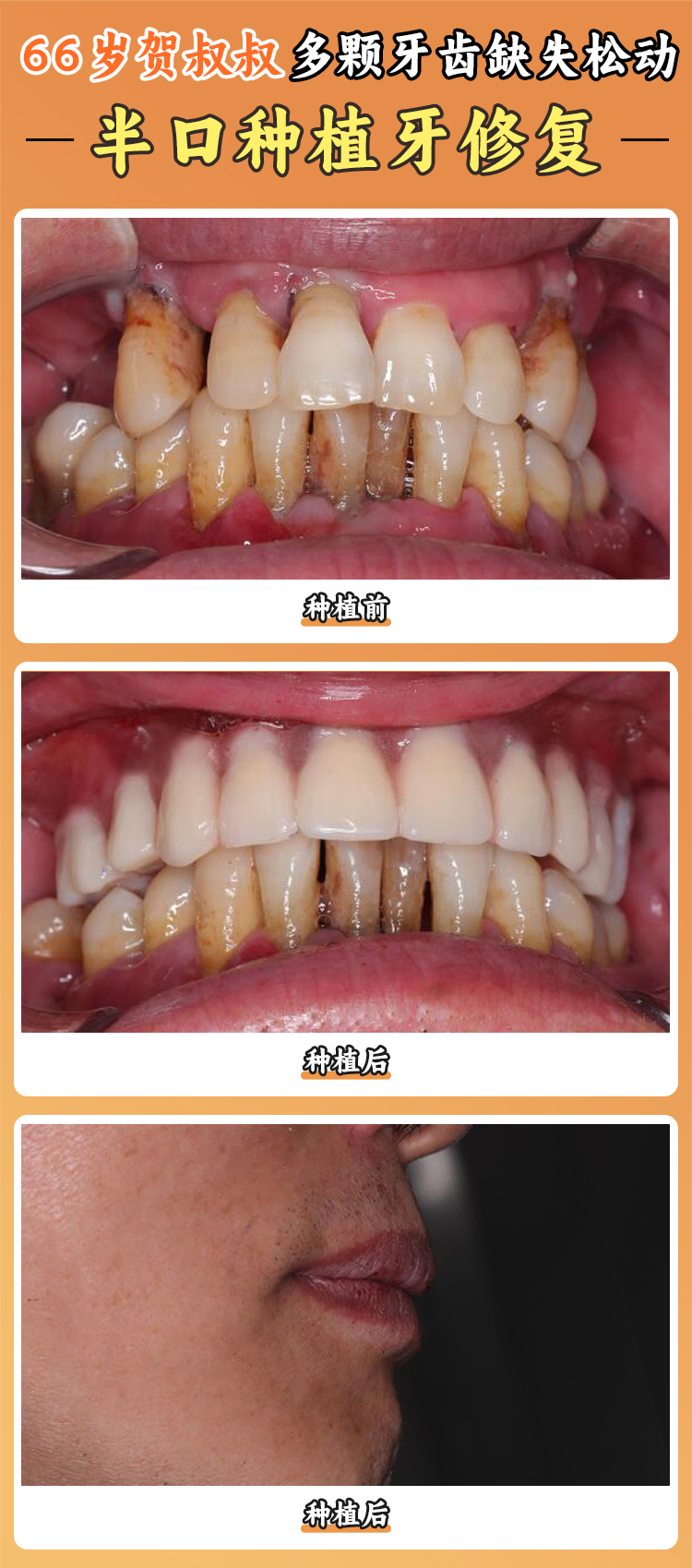 上海亿大口腔半口种植牙医生