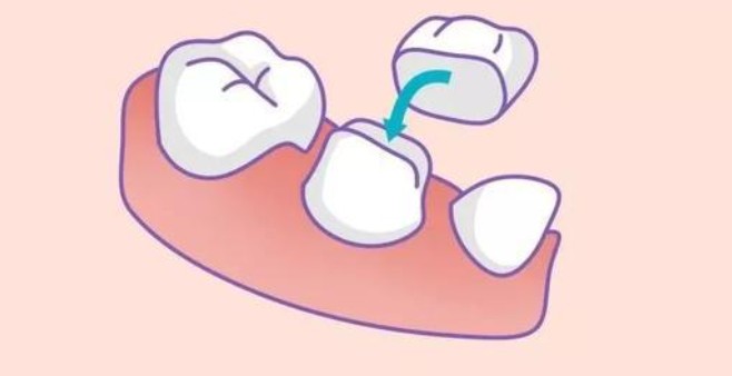 上海装全口假牙多少钱？活动/吸附性/种植义齿价格对比：2500-2.8万不等，附5家上海老人装假牙医院
