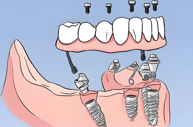 上海装全口假牙多少钱？活动/吸附性/种植义齿价格对比：2500-2.8万不等，附5家上海老人装假牙医院