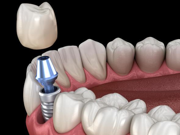 深圳千喜口腔收费标准2025新版公布！种植牙1980元起，矫正10000元起贵吗？