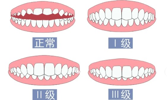 泸州微笑口腔正牙口碑好吗？是！用户亲测地包天矫正疗效明显，江阳店地址好找