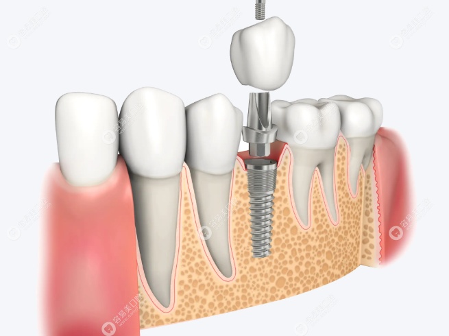 技术精掌握核心种植技术 技术精掌握核心种植技术