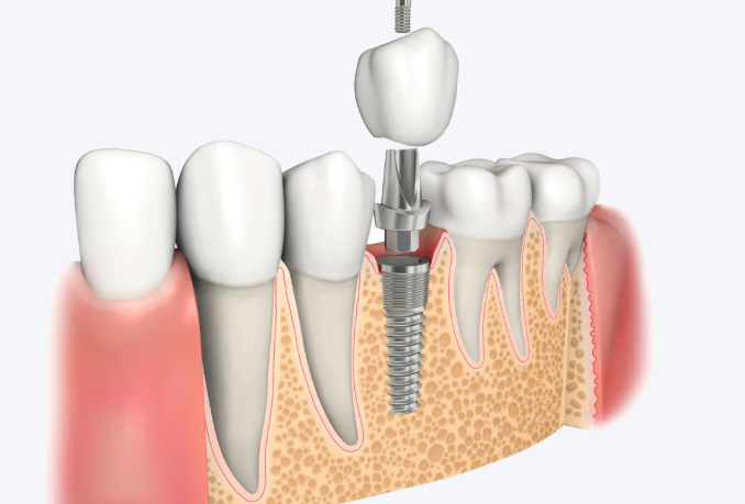 商洛小虎牙口腔电话曝光：0914-2317658联系小虎牙牙科种牙等项目
