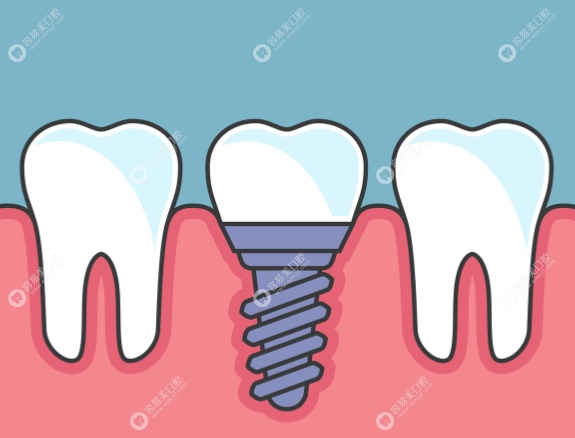 行業(yè)貢獻(xiàn)：推動(dòng)區(qū)域種植牙技術(shù)發(fā)展