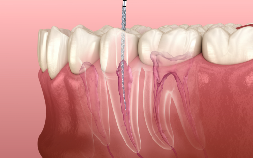 福州牙齿做根管治疗建议去医院还是诊所？费用差异等多维度大揭秘