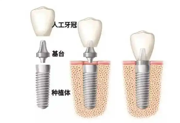 鹽城美奧爾口腔怎么樣？規(guī)模大資質(zhì)正規(guī)，種植牙技術(shù)穩(wěn)定！