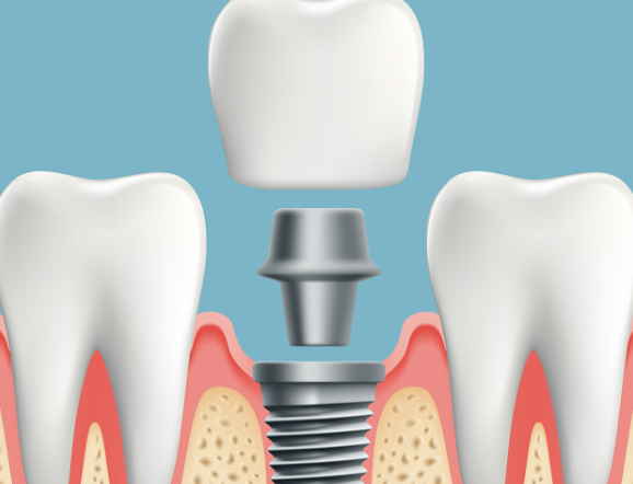 鹽城美奧爾口腔怎么樣？規(guī)模大資質(zhì)正規(guī)，種植牙技術(shù)穩(wěn)定！