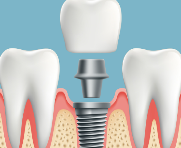 鹽城金融城倍美口腔預(yù)約電話(huà)是多少？(0515)88380008聯(lián)系補(bǔ)牙等很方便