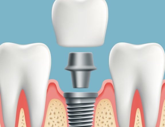 鹽城艾博口腔種植醫(yī)生介紹，張良鵬等實(shí)力醫(yī)生為您的缺牙問(wèn)題護(hù)航