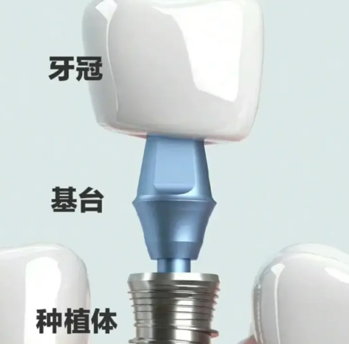 鹽城艾博口腔種植醫(yī)生介紹，張良鵬等實(shí)力醫(yī)生為您的缺牙問(wèn)題護(hù)航