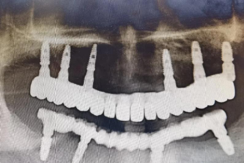 太原皓雅口腔院長劉建林怎么樣？分享我全口重建的真實經(jīng)歷，劉院長親診不僅技術(shù)好且脾氣超耐心