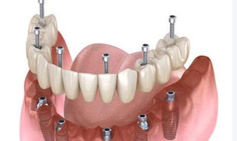 太原皓雅口腔院長(zhǎng)劉建林怎么樣？分享我全口重建的真實(shí)經(jīng)歷，劉院長(zhǎng)親診不僅技術(shù)好且脾氣超耐心