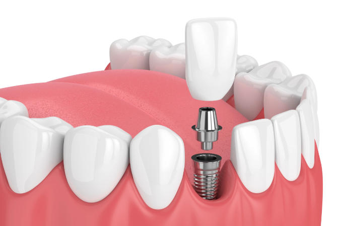 四、太原皓雅口腔院長(zhǎng)李恒信種植牙價(jià)格表
