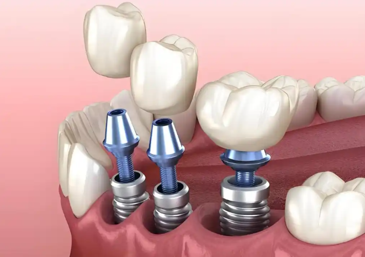 鹽城博笑口腔價(jià)目表新鮮出爐，隱形矯正、種植牙各項(xiàng)牙齒治療價(jià)格不貴