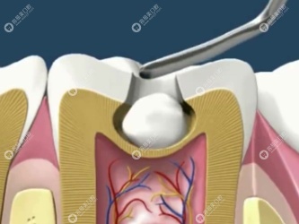3D全瓷仿生嵌体补牙