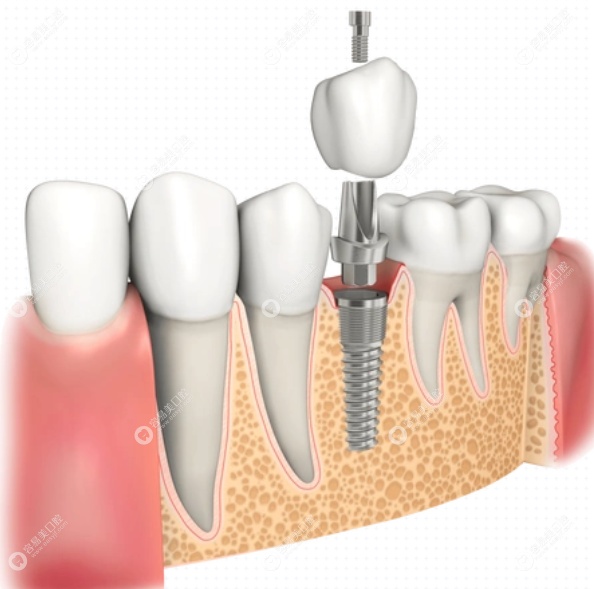 陈文医生种植牙优势