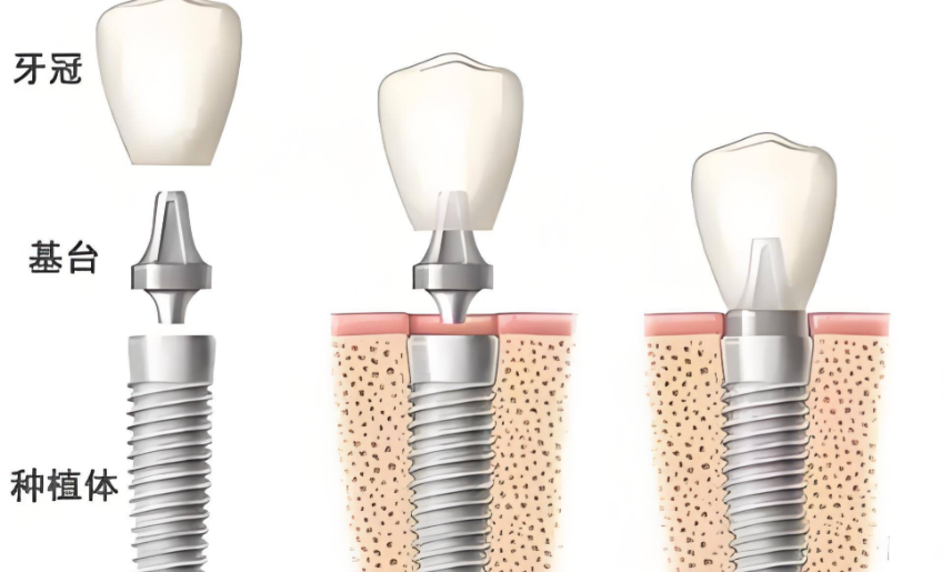 二、大连齿医生口腔种植牙价格：差异到底在哪里？www.easyjf.com