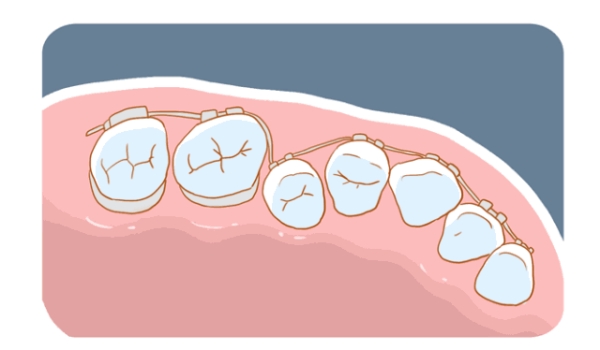 三、牙齿矫正省钱攻略