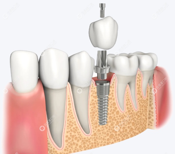 技术特色：微创、舒适