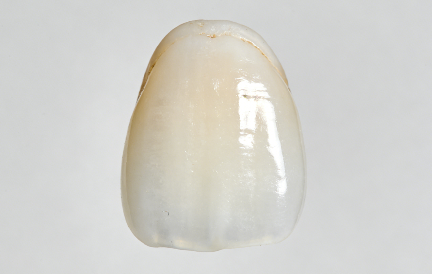 贵阳华美口腔牙贴面价格曝光，树脂贴面300起，瓷贴面1000起