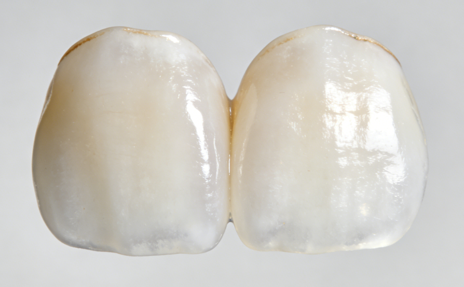 贵阳华美口腔牙贴面价格曝光，树脂贴面300起，瓷贴面1000起