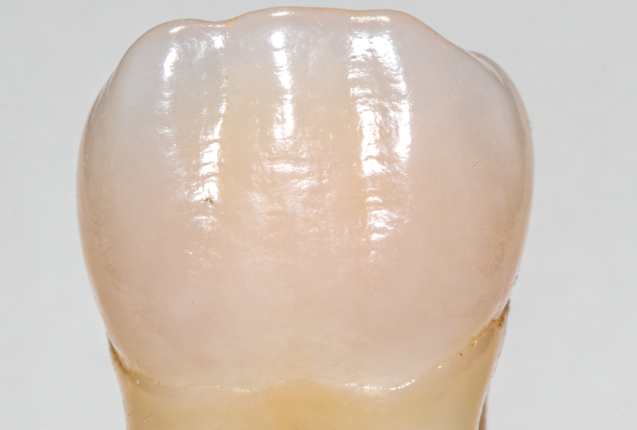 贵阳华美口腔牙贴面价格曝光，树脂贴面300起，瓷贴面1000起