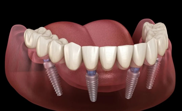 南京栖霞悦维口腔电话(025)85508889，联系种牙，洗牙等项目服务