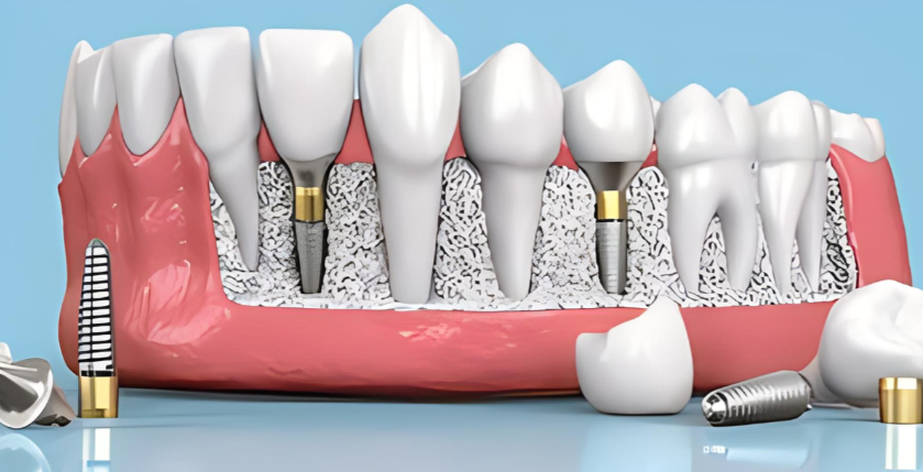 四、常见问题答疑：种牙前必看！