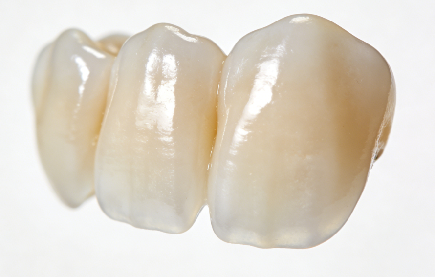 南京微芽口腔全瓷牙价格介绍：国产氧化锆全瓷等多种材质价格区间汇总