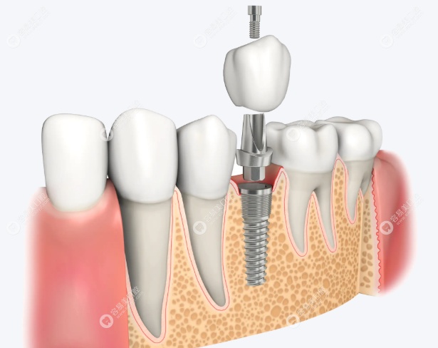 技术优势：疑难种植与数字化施治