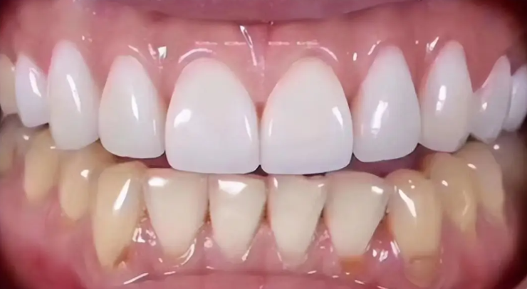 资中牙米口腔与简阳/乐至牙米对比：吸附性义齿技术更成熟