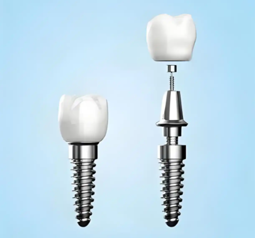 南通薄荷口腔种植牙价格大揭秘，瑞典种牙约13198元起，登腾种牙也便宜