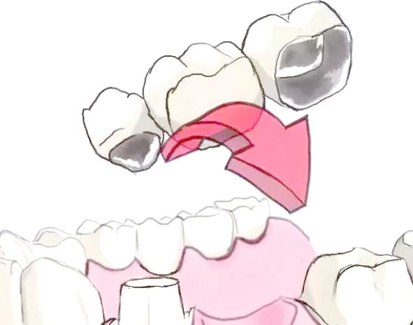 2026南通烤瓷牙价格表大揭秘，钛合金500元起，普通烤瓷牙200起