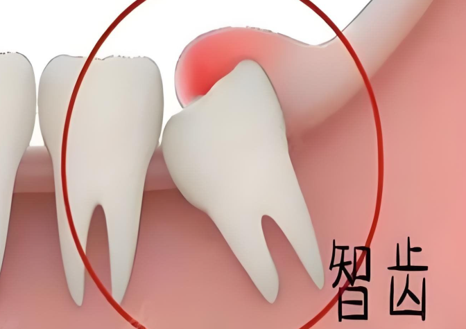 宝鸡小丁口腔能拔智齿注重心理疏导