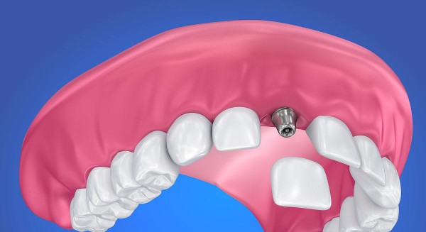 吉安種植牙哪家醫(yī)院好，口碑榜單更新，牙博士皓靚貝爾值得參考選擇
