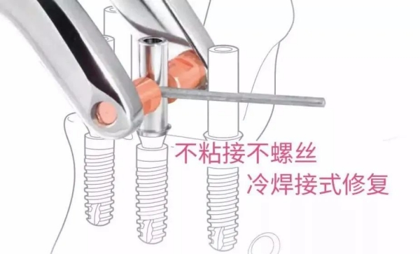 為什么合肥中諾口腔的種植牙價格這么有競爭力