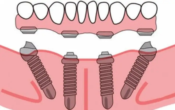 傳統(tǒng)種植牙