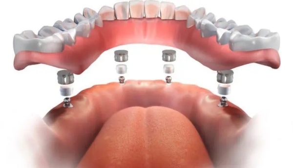 數(shù)字化種植牙