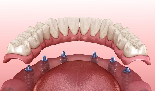 半口或全口缺牙